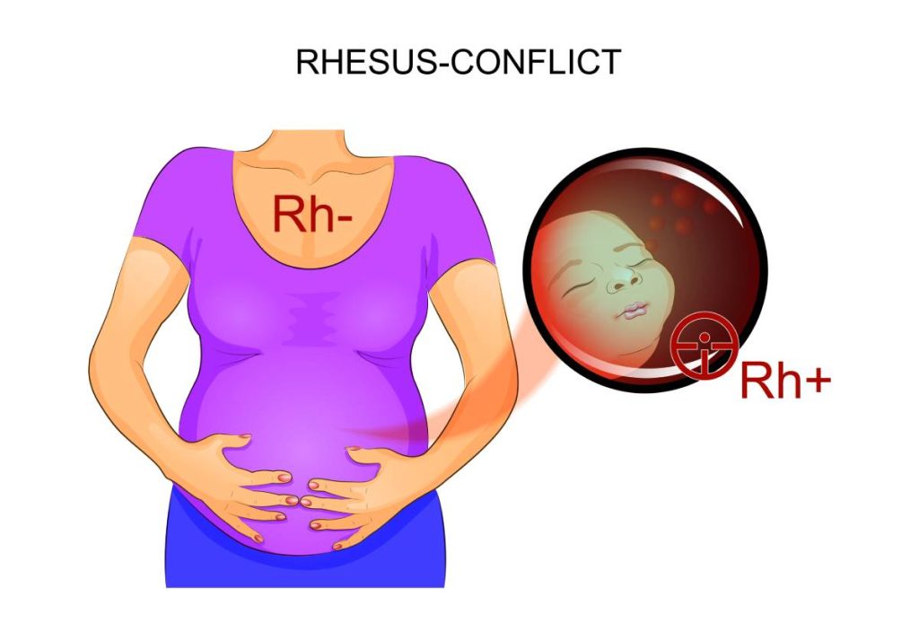 The Importance of Rh Factor in Pregnancy